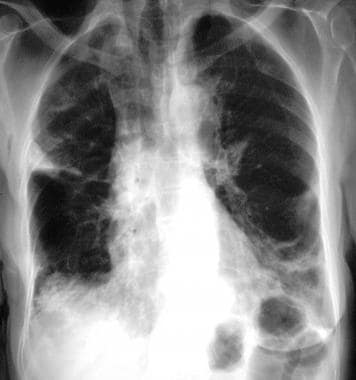 boop pneumonia x rays