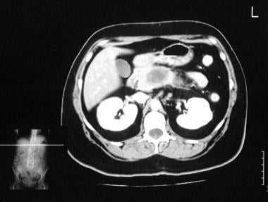 Chronic pancreatitis. Enhanced axial CT scan throu
