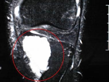 Fat-suppressed T2-weighted coronal MR image of the