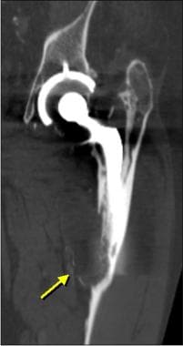 Image of the femoral component from a patient who 