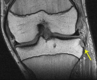 Segond fracture in a patient with an ACL tear. T1 