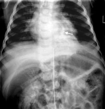 Intralobar pulmonary sequestration. An 8-year-old 