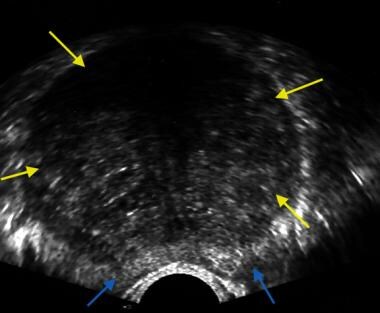 Transverse image of the prostate showing a hypertr