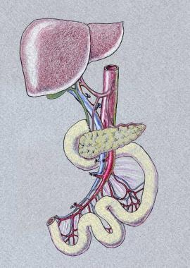 Liver-small bowel graft, including the pancreas. 