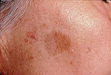 Actinic keratosis - eMedicineHealth