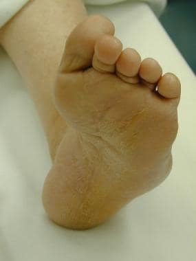 Varus foot deformity in patient with Charcot-Marie