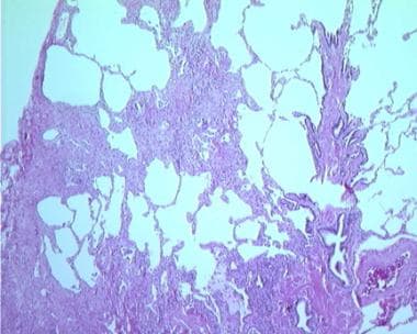 In usual interstitial pneumonitis or idiopathic pu