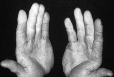 Photo of a patient with Raynaud phenomenon that re