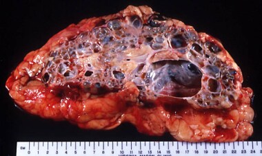 Cut surface of the same nephrectomy specimen from