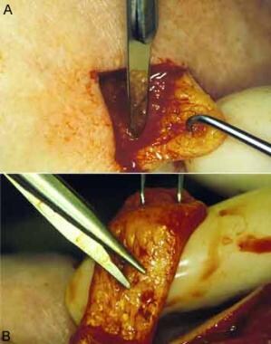 A is a flap elevation in the subcutaneous plan, su