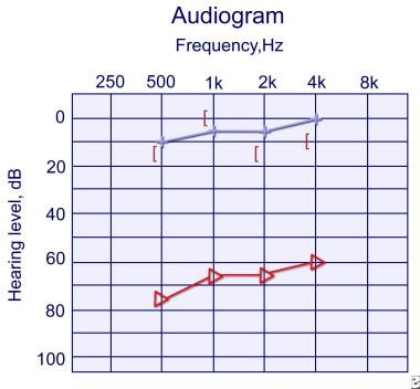Audiogram of 5-year-old girl with right unilateral