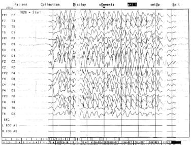 An 8-second burst of generalized 3-Hz spike and wa