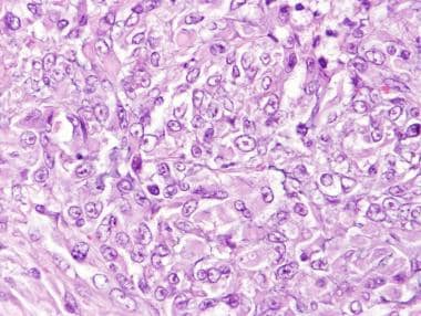 Cells with a rhabdoid morphology (rounded, pink cy