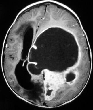 Case 3b. Anaplastic ependymoma of the lateral vent