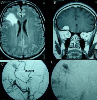 Frontal meningioma. A, B: Slow growth and surround