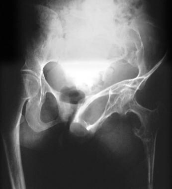 Plain radiograph of the pelvis in a 28-year-old wo