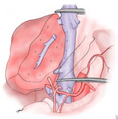 Drawing of an orthotopic liver transplant and the 