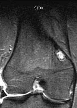 Coronal inversion-recovery MRI of the distal femur