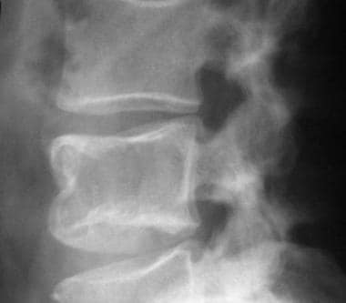 Lateral radiograph of the lumbar spine. This image