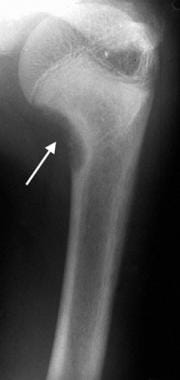 Anteroposterior radiograph of the humerus in a pat