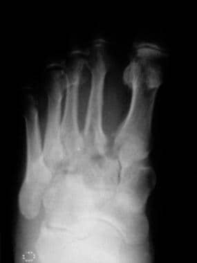 Fractured metatarsals. Image shows a Lisfranc frac