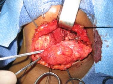 Intraoperative view of macrocystic lymphatic malfo