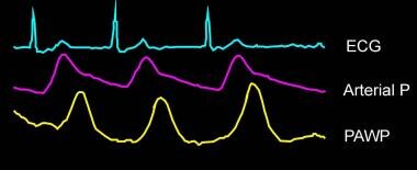 Timing of the pulmonary artery waveforms in relati