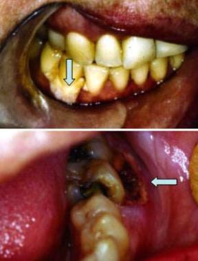 Histoplasmosis. Top image shows periodontal recess