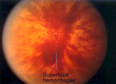 Recent onset central retinal vein occlusion, showi