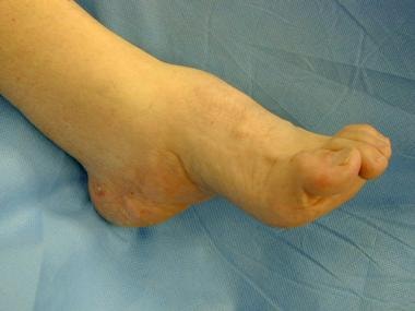 Cavovarus deformity with high-arched foot. Note ha
