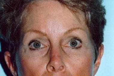 Postoperative photo 2 years after endoscopic brow