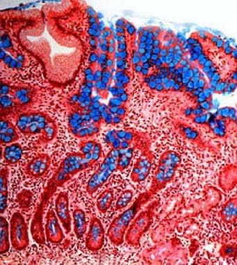 Atrophic gastritis. Intestinal metaplasia of the g