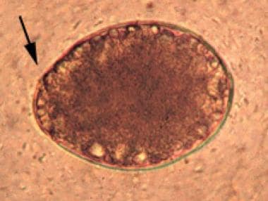 Egg of Diphyllobothrium latum with arrow pointing 