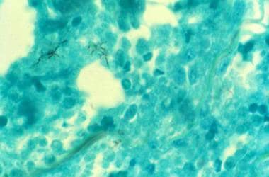Photomicrograph of tissue biopsy stained with Gomo