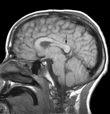 Resonancia magnética del cerebro (vista sagital) que muestra una resonancia magnética del cerebro (vista sagital) que muestra una hemorragia Duret en el esplenio del cuerpo calloso.