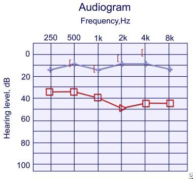 Audiogram 1 year later of same child as in precedi