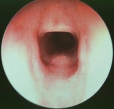 Subglottic view of very mild congenital subglottic
