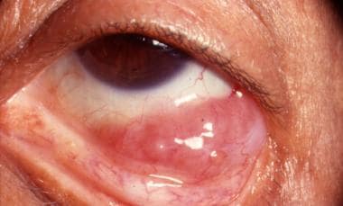 Salmon-pink appearance of conjunctival lymphoma. 