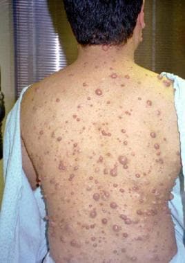 Multiple neurofibromas in 28-year-old man. 