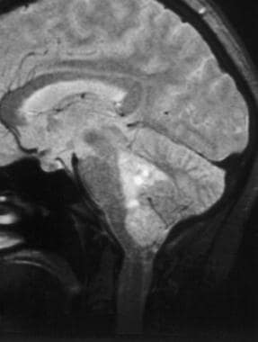 Case 4a. Ependymoma arising from the fourth ventri