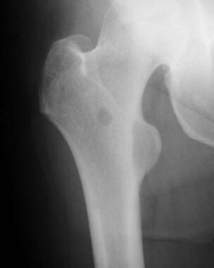 Radiograph of the right femur. This image demonstr