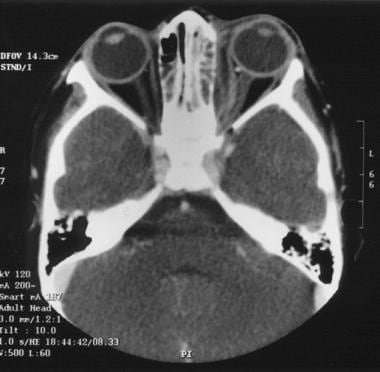 Surgical treatment of acute maxillary sinusitis. T