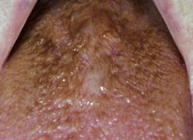 Hairy Tongue Disorder 105