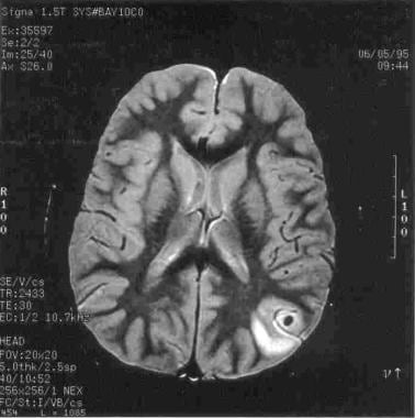 Magnetic resonance image (MRI) of the brain in a p