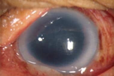 Diffuse illumination showing Descemet membrane fol