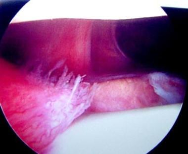 Plica syndrome. Typical appearance of a large beef