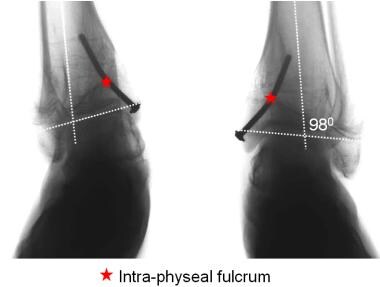 A drawback of the intraphyseal fulcrum is the rigi