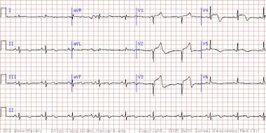 Heart Failure. This electrocardiogram shows a pati