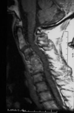 Severe cervical spondylosis can manifest as a comb