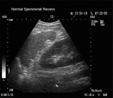 Blunt abdominal trauma. Normal splenorenal recess.